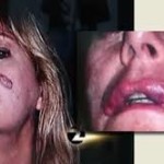 cosmetic surgery bad effects (9)